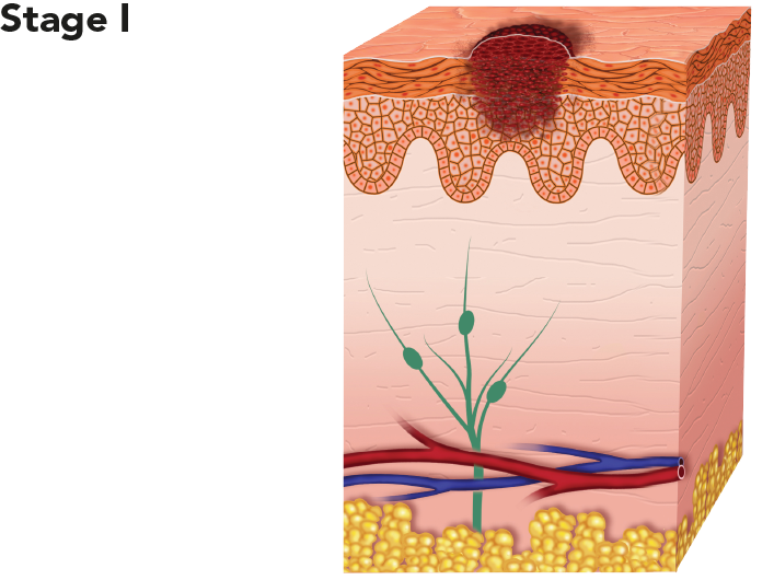 Diagram showing melanoma at stage I
