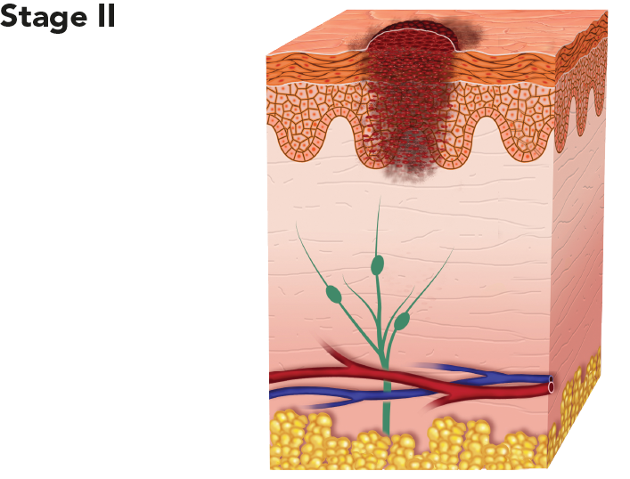 Diagram showing melanoma at stage II