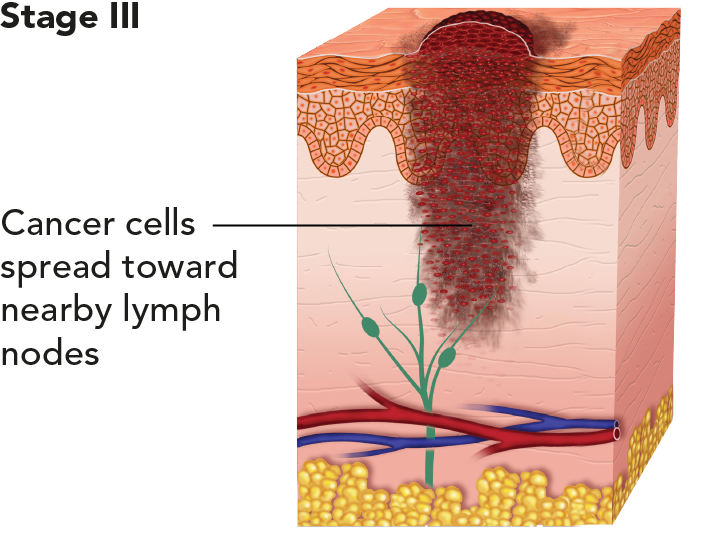 Diagram showing melanoma at stage III