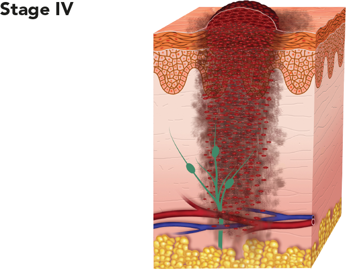 Diagram showing melanoma at stage IV
