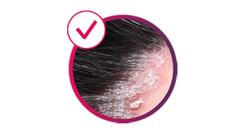 Image depicting scalp PsO. Image depicting scalp PsO.