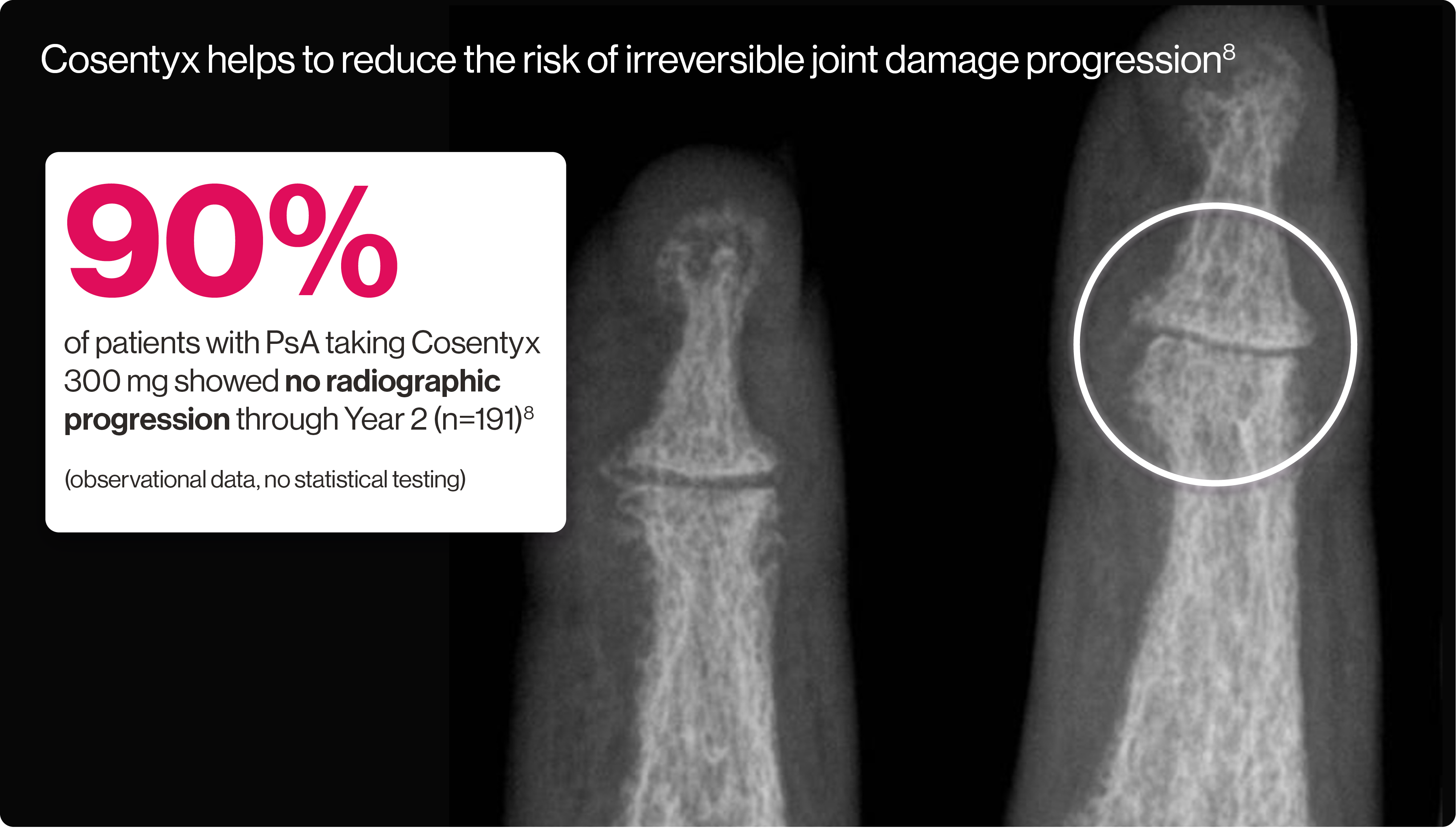Image showing an artist’s representation of early radiographic damage. Image showing an artist’s representation of early radiographic damage.