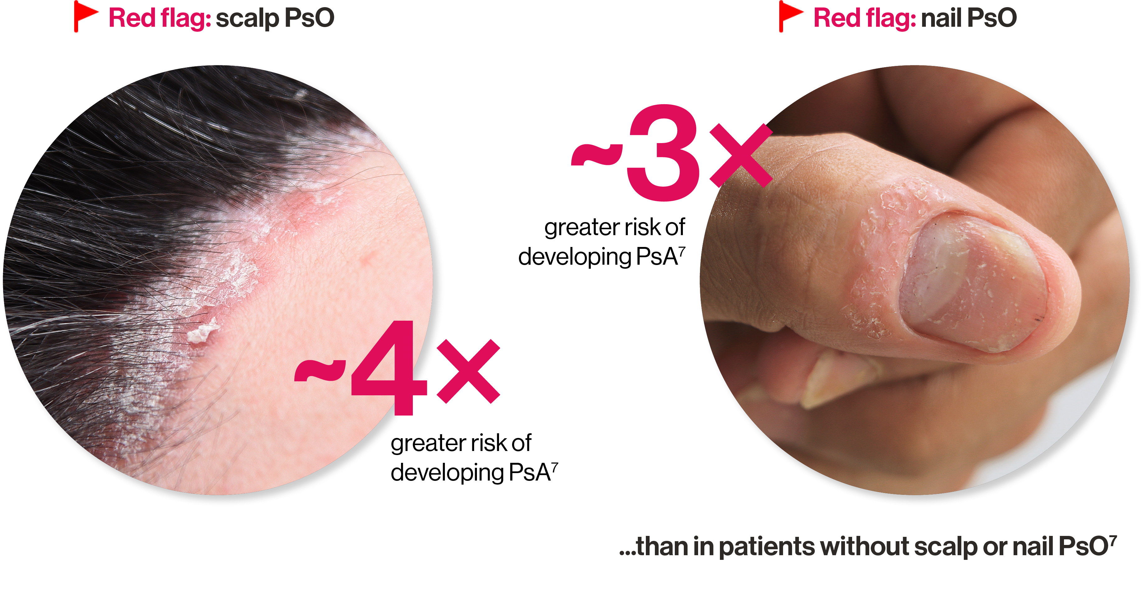 An image showing scalp PsO with the text '4x greater risk of developing PsA7’ and image of nail PsO with the text 'greater risk of developing PsA7’ ... than in patients without scalp or nail PsO7. An image showing scalp PsO with the text '4x greater risk of developing PsA7’ and image of nail PsO with the text 'greater risk of developing PsA7’ ... than in patients without scalp or nail PsO7.