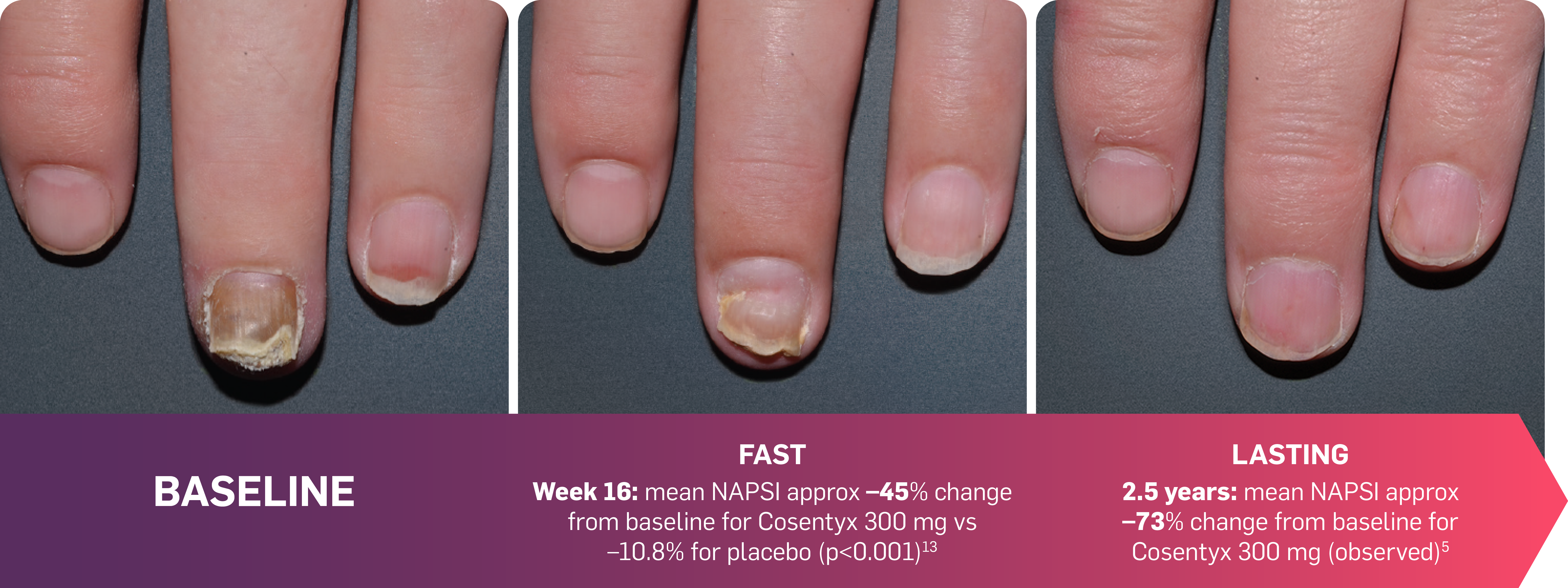 Graphic featuring 3 images showing NAPSI results through to 2.5 years. Graphic featuring 3 images showing NAPSI results through to 2.5 years.