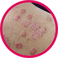 Circular image of skin with psoriasis Circular image of skin with psoriasis