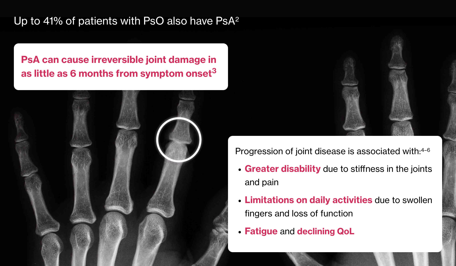 Image showing an artist’s representation of early radiographic damage. Image showing an artist’s representation of early radiographic damage.