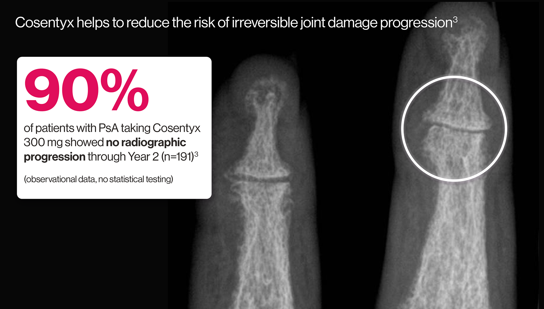 Artist's representation of early radiographic damage.