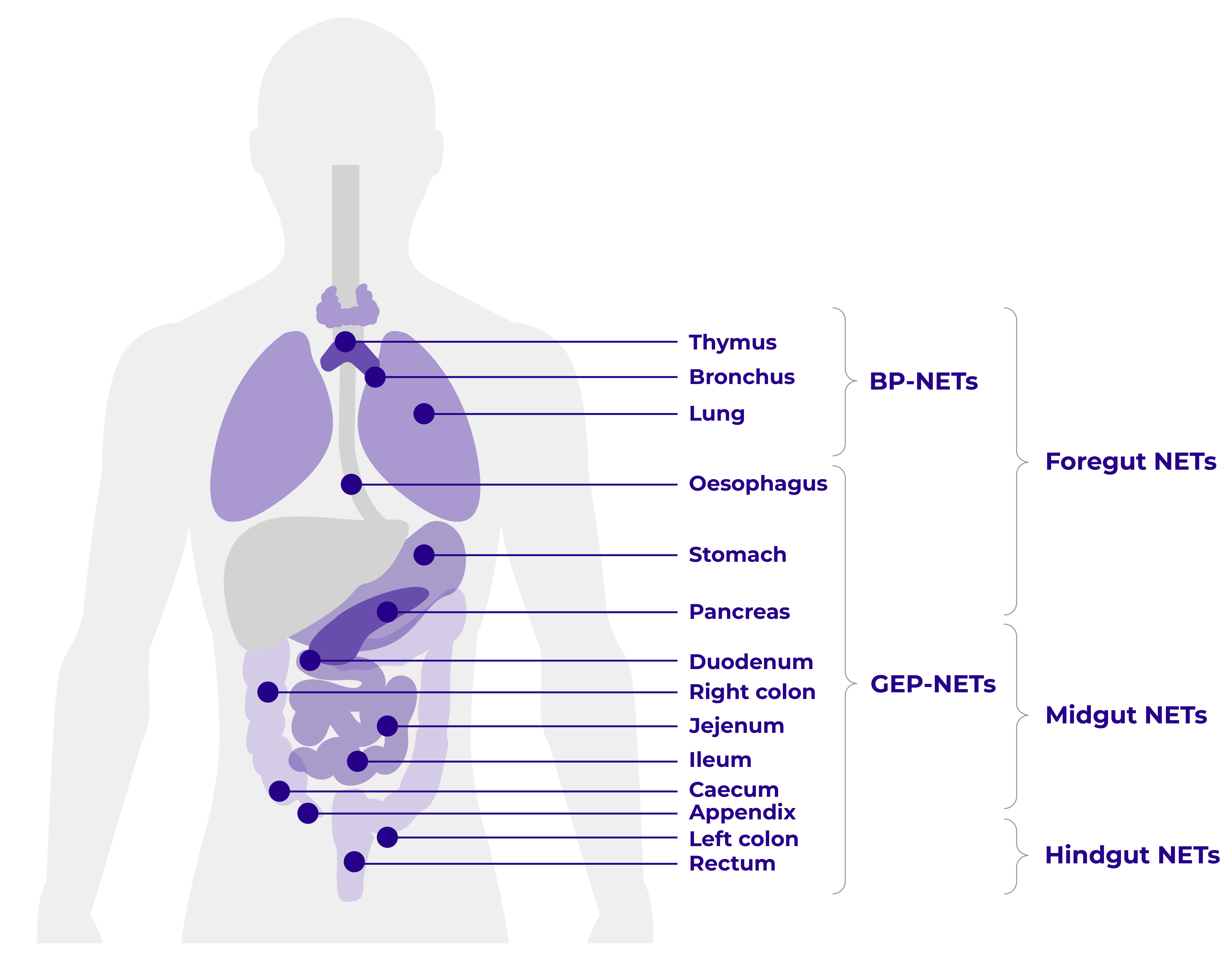 Diagram of the abdomen and upper body showing the anatomical classification of NETs.