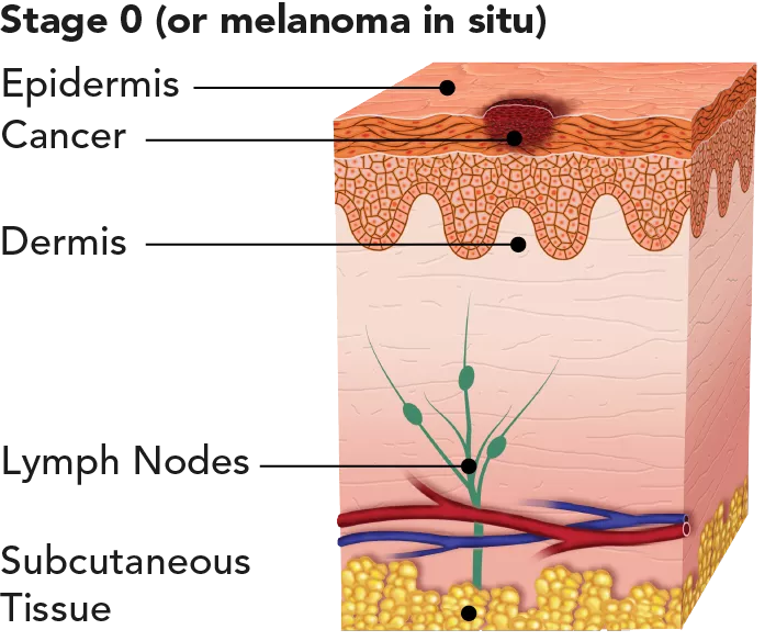 Diagram showing melanoma at stage 0 (melanoma in situ)