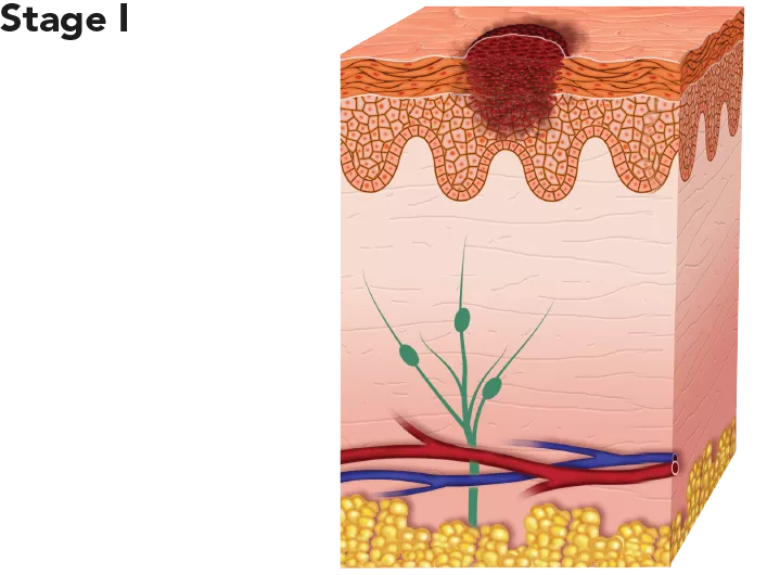 Diagram showing melanoma at stage I