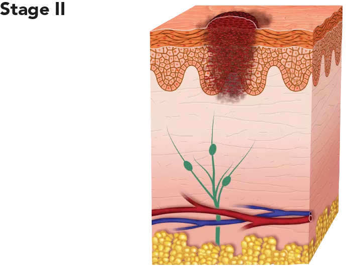 Diagram showing melanoma at stage II