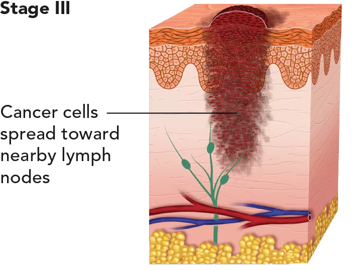 Diagram showing melanoma at stage III