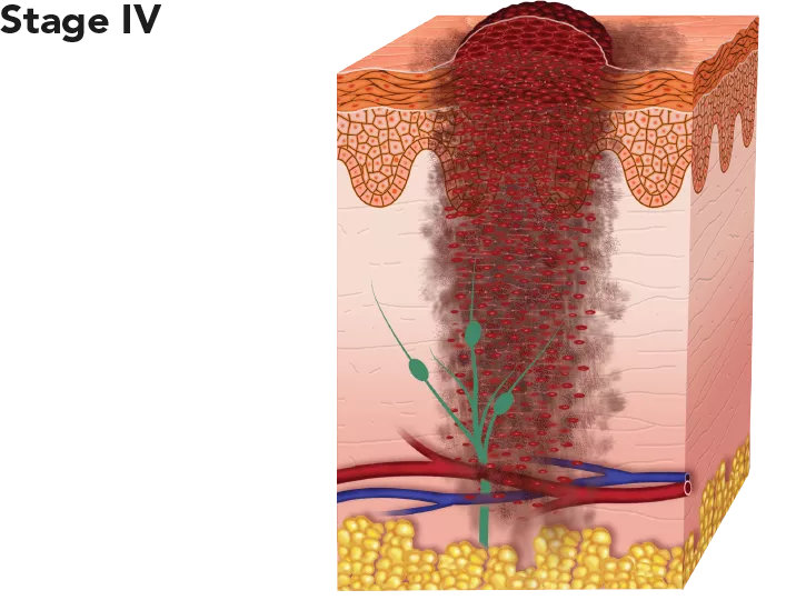 Diagram showing melanoma at stage IV