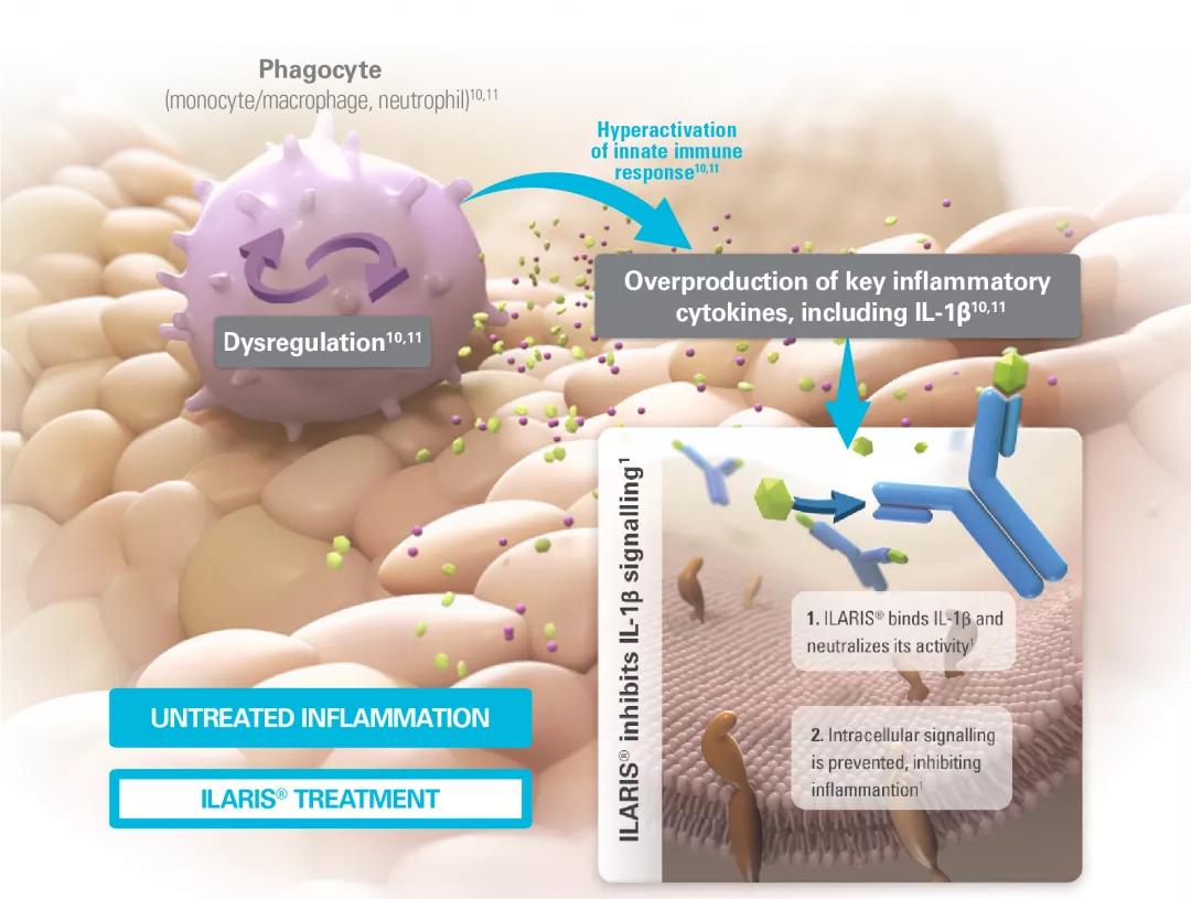 Image showing the mechanism of action of ILARIS in periodic fever syndromes.