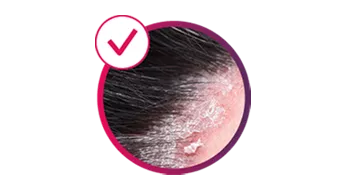 Image depicting scalp PsO.