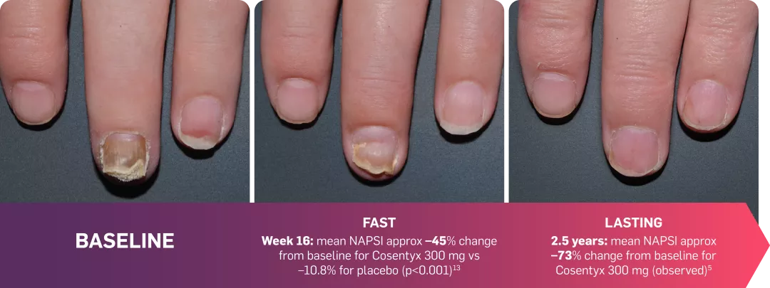 Graphic featuring 3 images showing NAPSI results through to 2.5 years.
