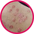 Circular image of skin with psoriasis