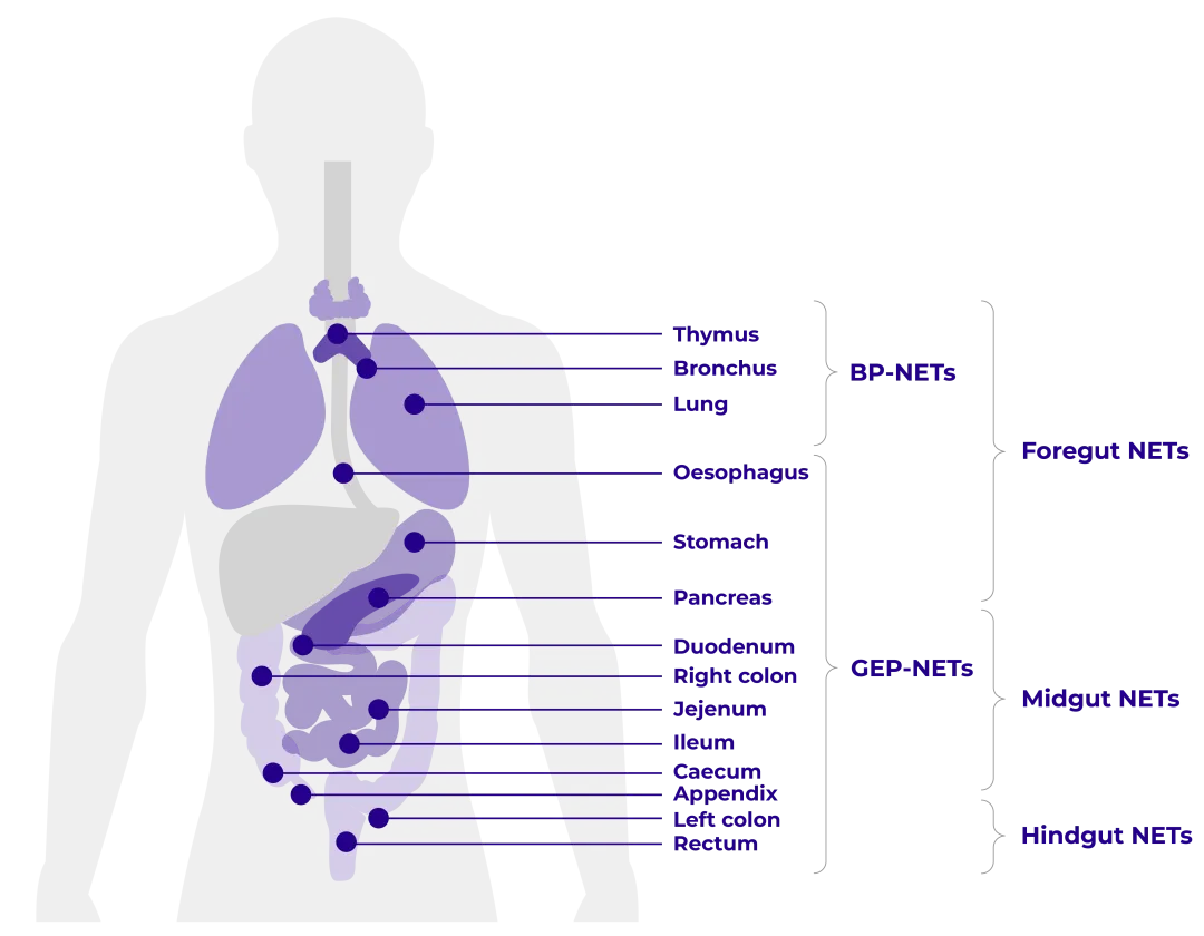 Diagram of the abdomen and upper body showing the anatomical classification of NETs.